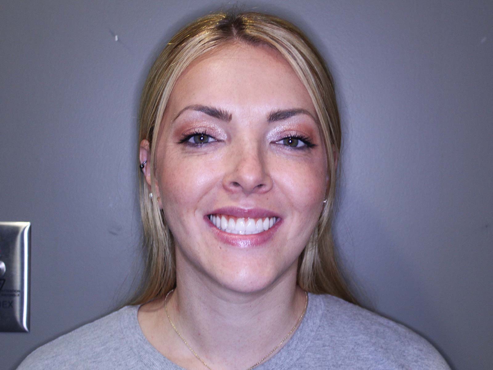 Completed implant teeth at Implants 4 Life